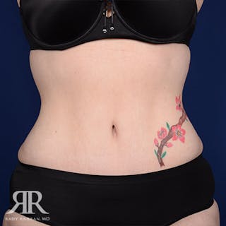 Tummy Tuck Before & After Gallery - Patient 101015 - Image 2