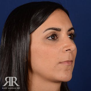 Female Rhinoplasty Before & After Gallery - Patient 162089 - Image 4