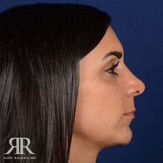 Female Rhinoplasty Before & After Gallery - Patient 162089 - Image 6