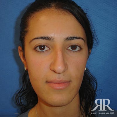Ethnic Rhinoplasty Before & After Gallery - Patient 358458 - Image 1