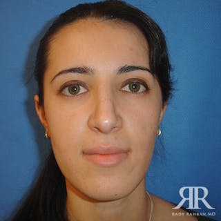 Ethnic Rhinoplasty Before & After Gallery - Patient 358458 - Image 2