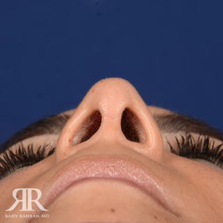 Female Rhinoplasty Before & After Gallery - Patient 162089 - Image 8