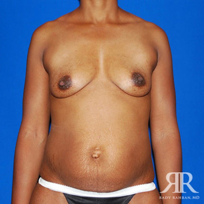 Mommy Makeover Before & After Gallery - Patient 253438 - Image 1