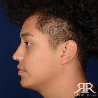 Chin Augmentation Before & After Gallery - Patient 188441 - Image 6