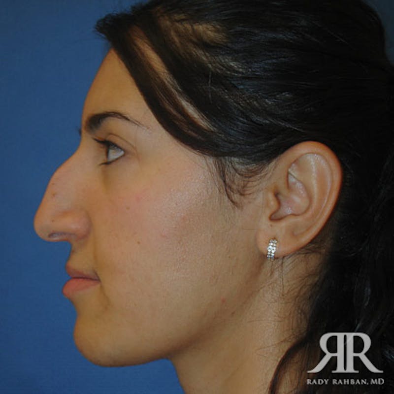 Ethnic Rhinoplasty Before & After Gallery - Patient 358458 - Image 3
