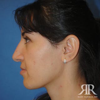 Ethnic Rhinoplasty Before & After Gallery - Patient 358458 - Image 4