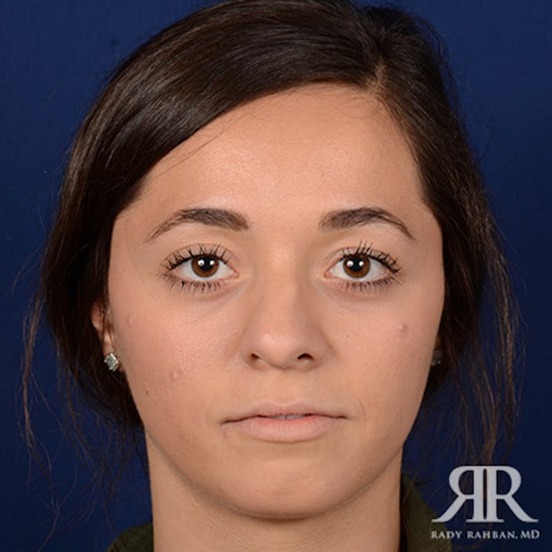 Female Rhinoplasty Before & After Gallery - Patient 272086 - Image 1