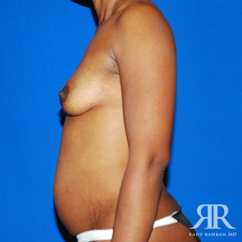 Mommy Makeover Before & After Gallery - Patient 253438 - Image 3
