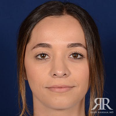 Female Rhinoplasty Before & After Gallery - Patient 272086 - Image 2