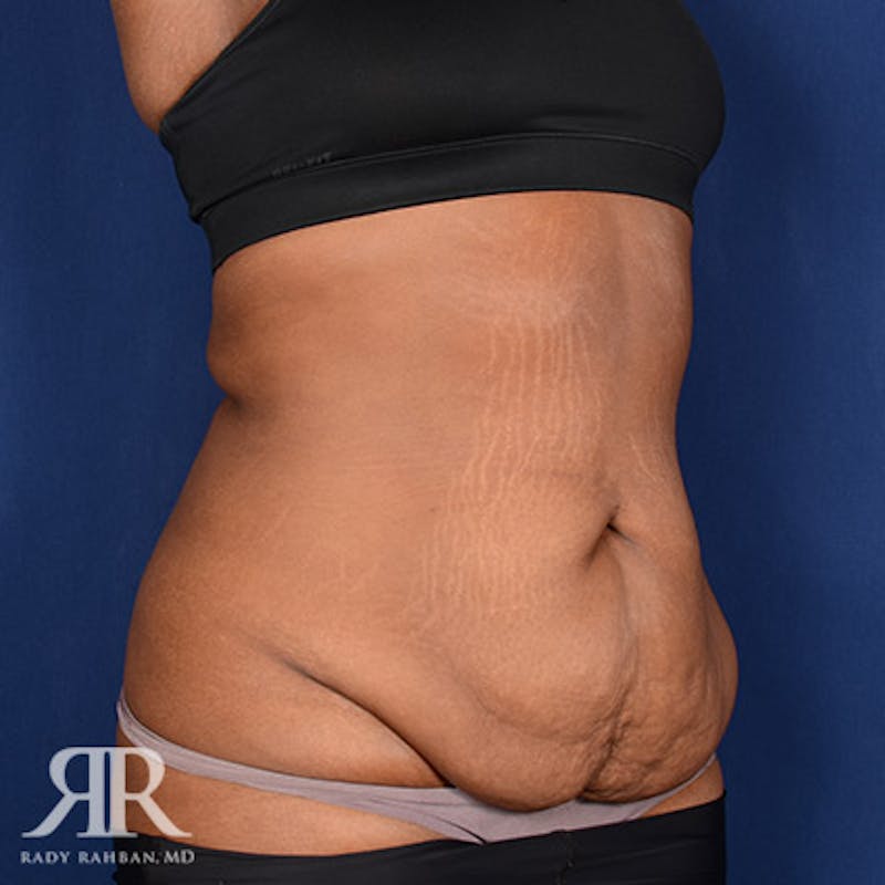 Tummy Tuck Before & After Gallery - Patient 911933 - Image 3