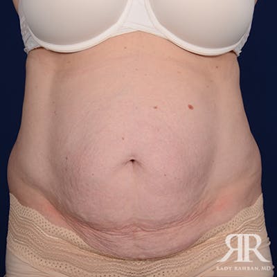 Severe Diastasis Recti Before & After Gallery - Patient 282606 - Image 1