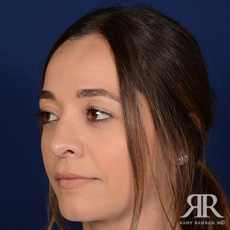 Female Rhinoplasty Before & After Gallery - Patient 272086 - Image 4