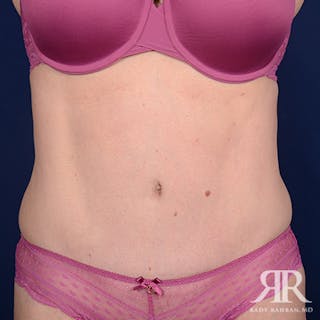 Severe Diastasis Recti Before & After Gallery - Patient 282606 - Image 2
