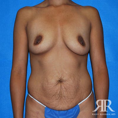 Mommy Makeover Before & After Gallery - Patient 422970 - Image 1