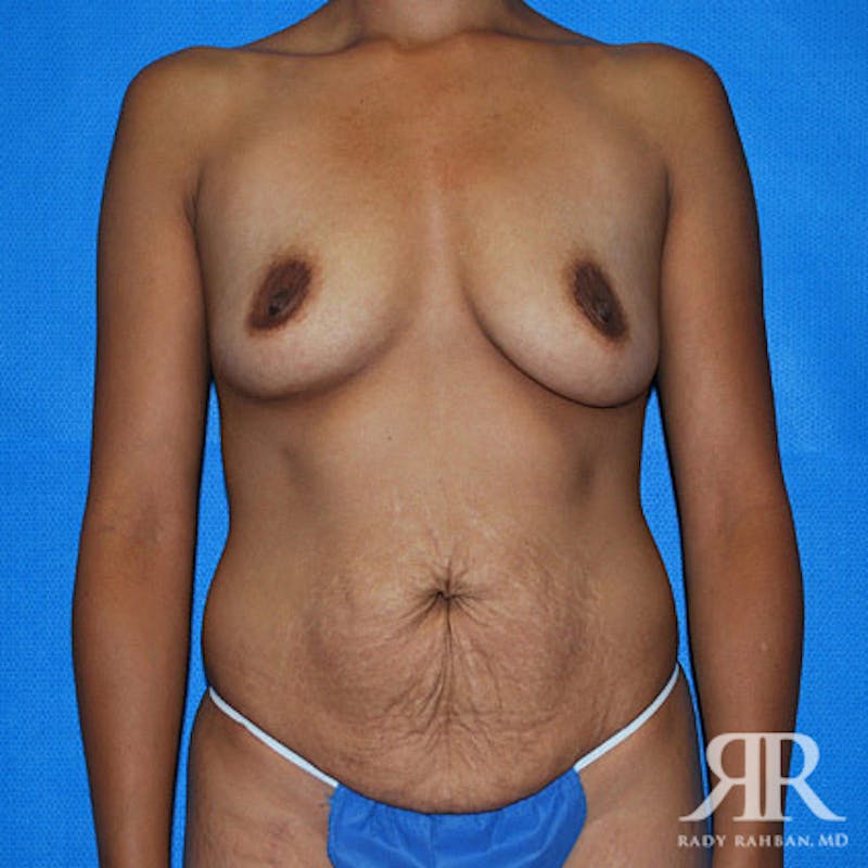 Mommy Makeover Before & After Gallery - Patient 422970 - Image 1