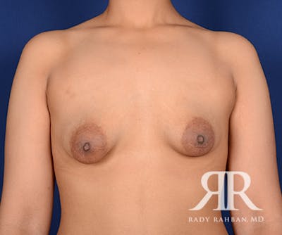 Breast Lift Before & After Gallery - Patient 246513 - Image 1