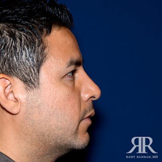 Ethnic Rhinoplasty Before & After Gallery - Patient 135787 - Image 6