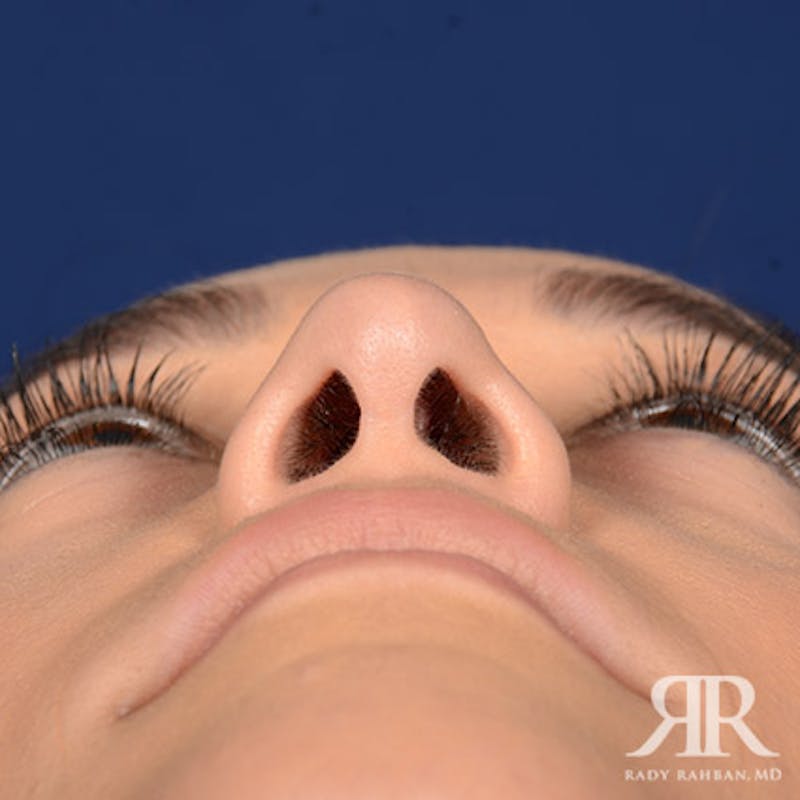 Female Rhinoplasty Before & After Gallery - Patient 272086 - Image 8
