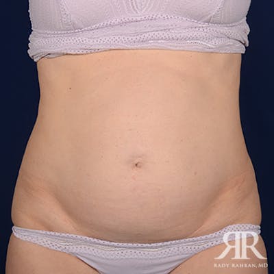 Severe Diastasis Recti Before & After Gallery - Patient 181345 - Image 1