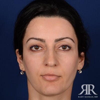 Female Rhinoplasty Before & After Gallery - Patient 155207 - Image 1