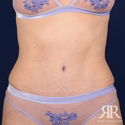 Severe Diastasis Recti Before & After Gallery - Patient 181345 - Image 2