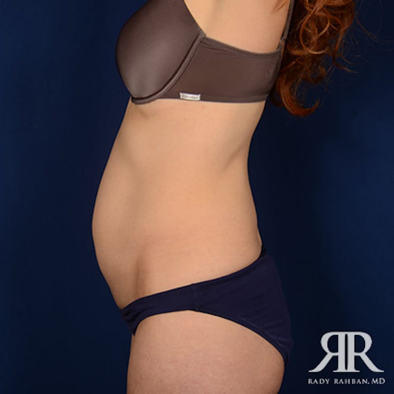 Tummy Tuck Before & After Gallery - Patient 307238 - Image 5