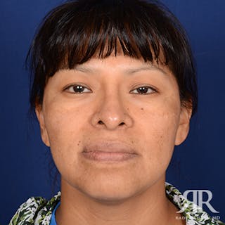 Ethnic Rhinoplasty Before & After Gallery - Patient 387837 - Image 2