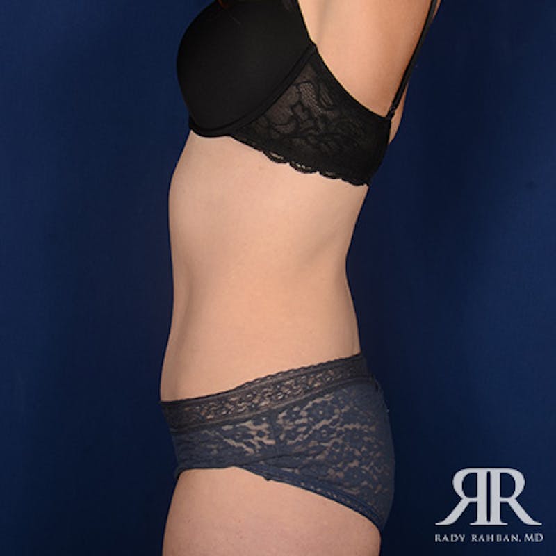 Tummy Tuck Before & After Gallery - Patient 307238 - Image 6