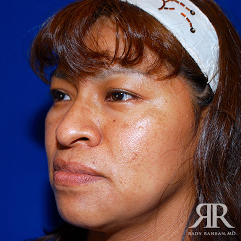 Ethnic Rhinoplasty Before & After Gallery - Patient 387837 - Image 3