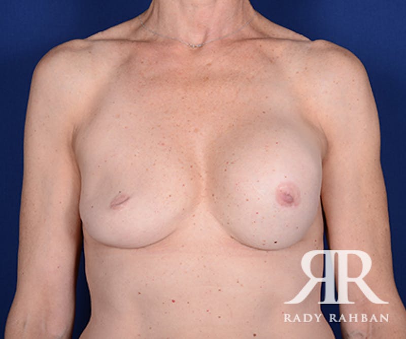 Corrective Breast Surgery Before & After Gallery - Patient 347823 - Image 1