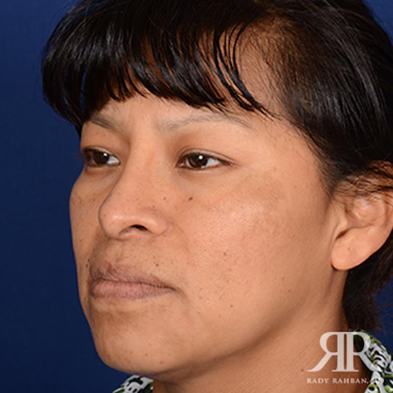 Ethnic Rhinoplasty Before & After Gallery - Patient 387837 - Image 4