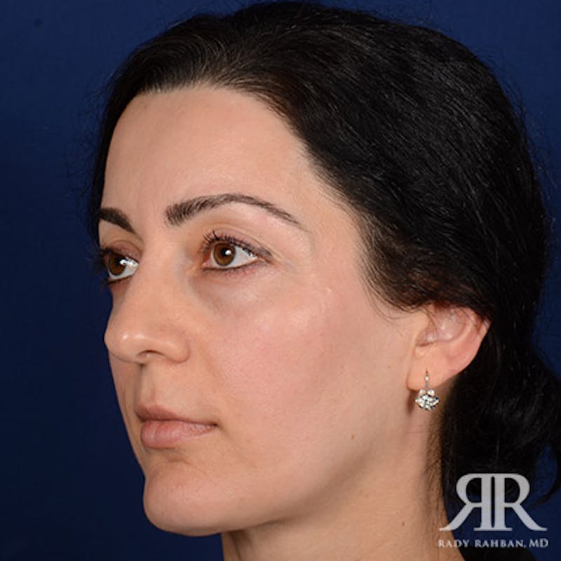 Female Rhinoplasty Before & After Gallery - Patient 155207 - Image 4