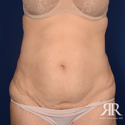 Tummy Tuck Before & After Gallery - Patient 193103 - Image 1