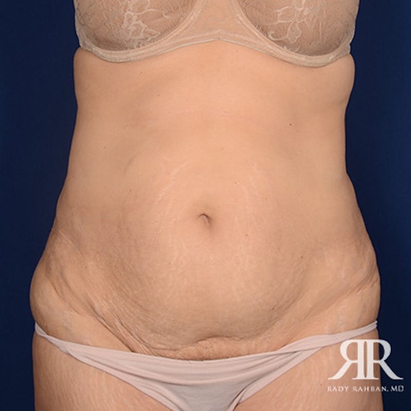 Tummy Tuck Before & After Gallery - Patient 193103 - Image 1
