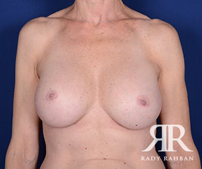 Corrective Breast Surgery Before & After Gallery - Patient 347823 - Image 2