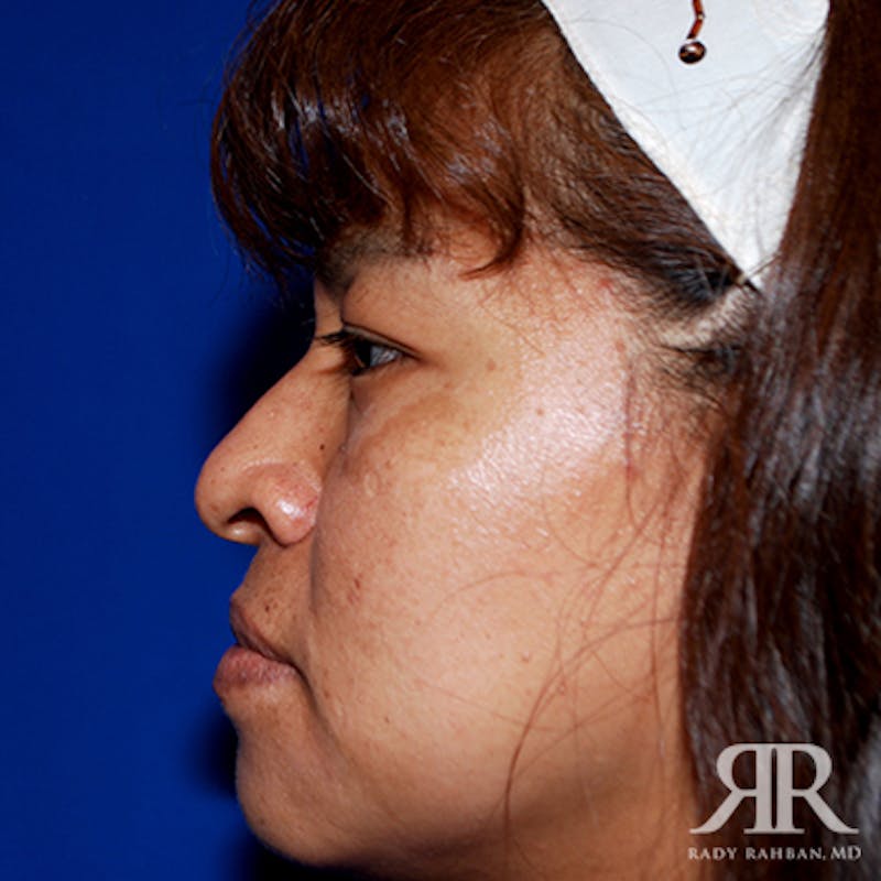 Ethnic Rhinoplasty Before & After Gallery - Patient 387837 - Image 5