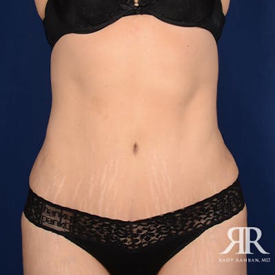 Tummy Tuck Before & After Gallery - Patient 193103 - Image 2