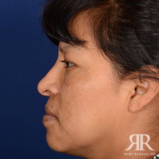 Ethnic Rhinoplasty Before & After Gallery - Patient 387837 - Image 6
