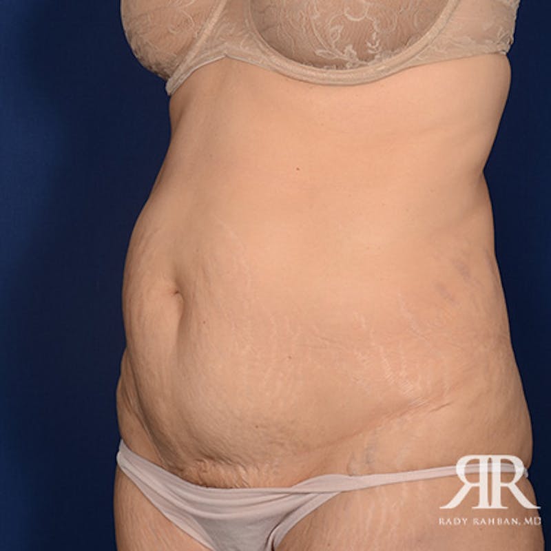 Tummy Tuck Before & After Gallery - Patient 193103 - Image 3