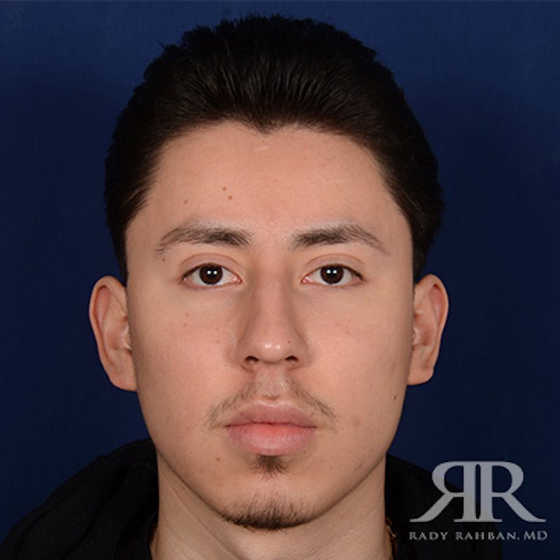 Chin Augmentation Before & After Gallery - Patient 428154 - Image 1