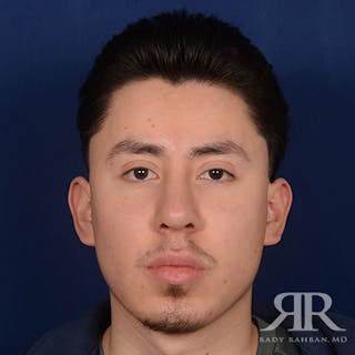 Chin Augmentation Before & After Gallery - Patient 428154 - Image 2