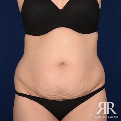 Severe Diastasis Recti Before & After Gallery - Patient 153551 - Image 1