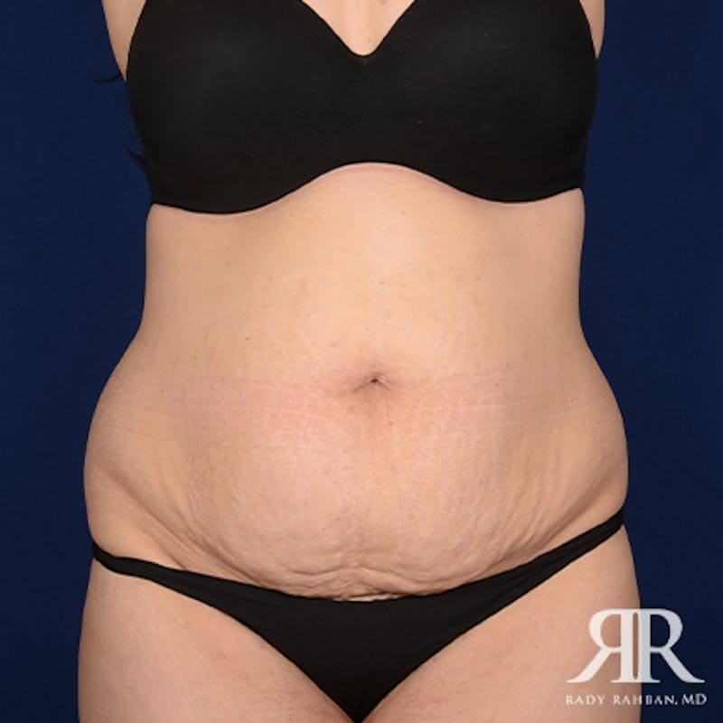Severe Diastasis Recti Before & After Gallery - Patient 153551 - Image 1