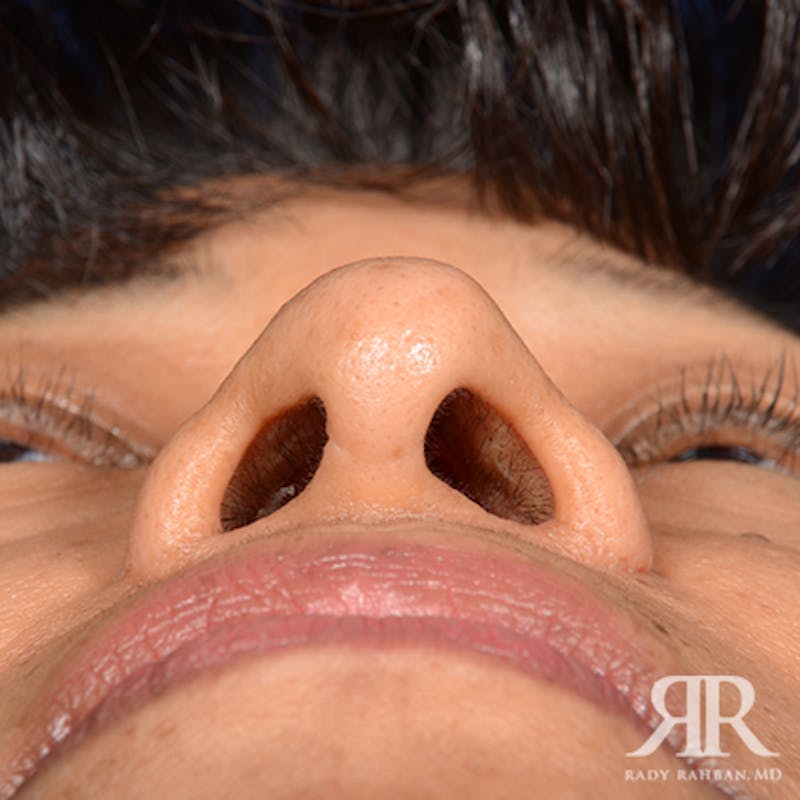 Ethnic Rhinoplasty Before & After Gallery - Patient 387837 - Image 8