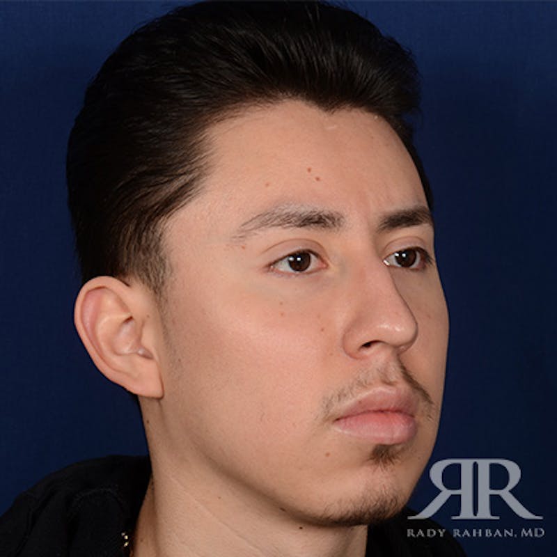 Chin Augmentation Before & After Gallery - Patient 428154 - Image 3