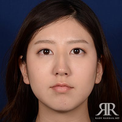 Female Rhinoplasty Before & After Gallery - Patient 337652 - Image 1