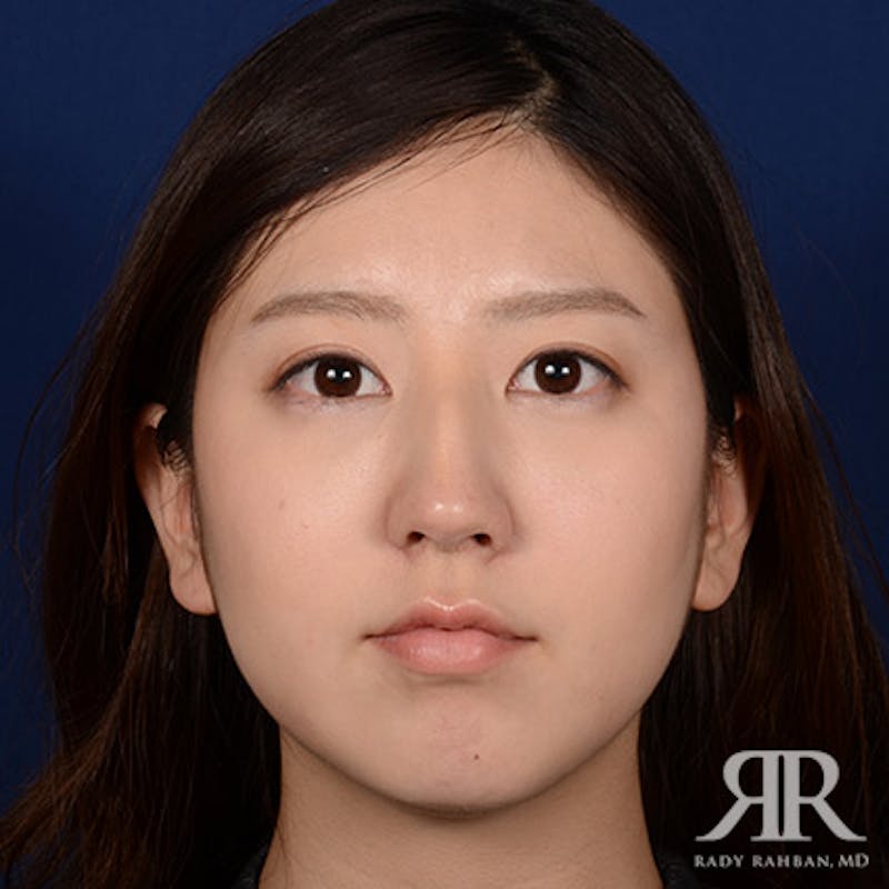 Female Rhinoplasty Before & After Gallery - Patient 337652 - Image 1