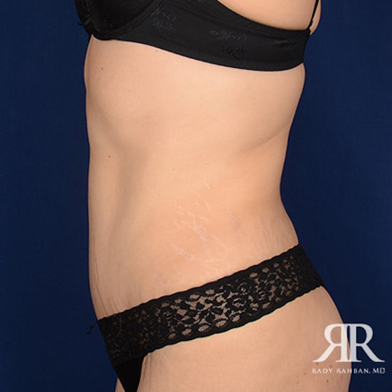 Tummy Tuck Before & After Gallery - Patient 193103 - Image 6