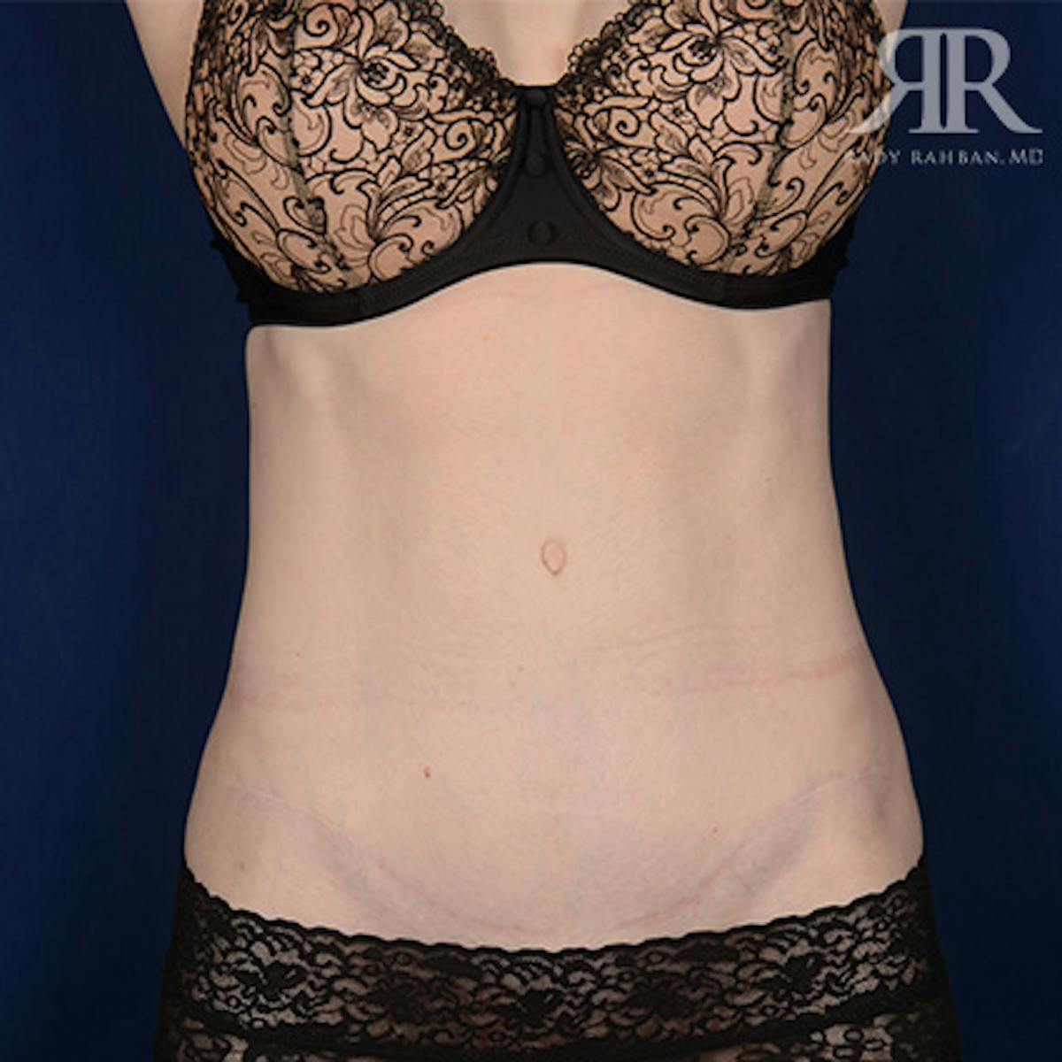 Tummy Tuck Scars Before & After Gallery - Patient 249966 - Image 1