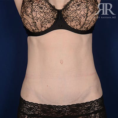 Tummy Tuck Scars Before & After Gallery - Patient 249966 - Image 1